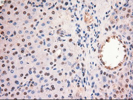 MYC / c-Myc Antibody - IHC of paraffin-embedded Carcinoma of Human liver tissue using anti-MYC mouse monoclonal antibody.