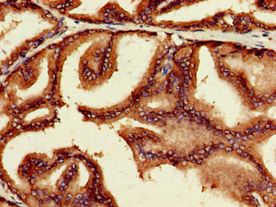 MYC / c-Myc Antibody - Immunohistochemistry of paraffin-embedded human prostate cancer using MYC Antibody at dilution of 1:100