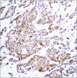 MYC / c-Myc Antibody - Detection of Myc (phospho-Thr58) in paraffin-embedded human breast carcinoma tissue.