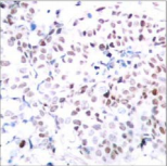 MYC / c-Myc Antibody - Detection of Myc (phospho-Thr358) in paraffin-embedded human breast carcinoma tissue.