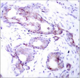MYC / c-Myc Antibody - Detection of Myc (phospho-Ser373) in paraffin-embedded human breast carcinoma tissue.