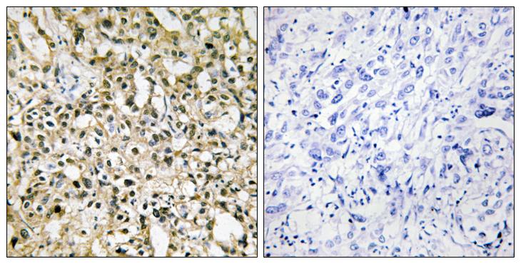 MYC / c-Myc Antibody - Peptide - + Immunohistochemistry analysis of paraffin-embedded human liver carcinoma tissue using Myc antibody.