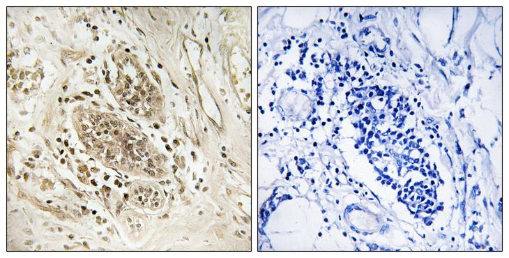 MYC / c-Myc Antibody - Peptide - + Immunohistochemistry analysis of paraffin-embedded human breast carcinoma tissue using POLE1 antibody.