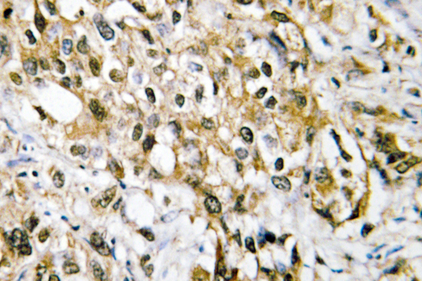 MYC / c-Myc Antibody - IHC of c-Myc (K422) pAb in paraffin-embedded human liver carcinoma tissue.