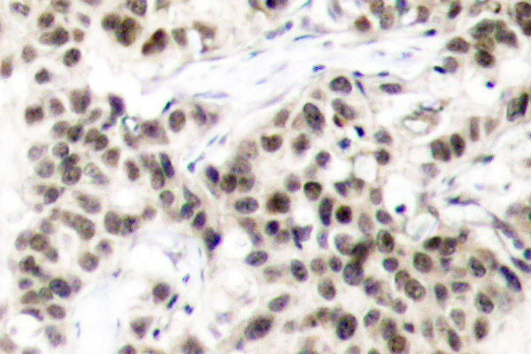 MYC / c-Myc Antibody - IHC of Myc (K52) pAb in paraffin-embedded human breast carcinoma breast carcinoma tissue.