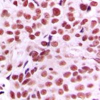 MYC / c-Myc Antibody - Immunohistochemical analysis of c-Myc staining in human breast cancer formalin fixed paraffin embedded tissue section. The section was pre-treated using heat mediated antigen retrieval with sodium citrate buffer (pH 6.0). The section was then incubated with the antibody at room temperature and detected using an HRP conjugated compact polymer system. DAB was used as the chromogen. The section was then counterstained with hematoxylin and mounted with DPX.