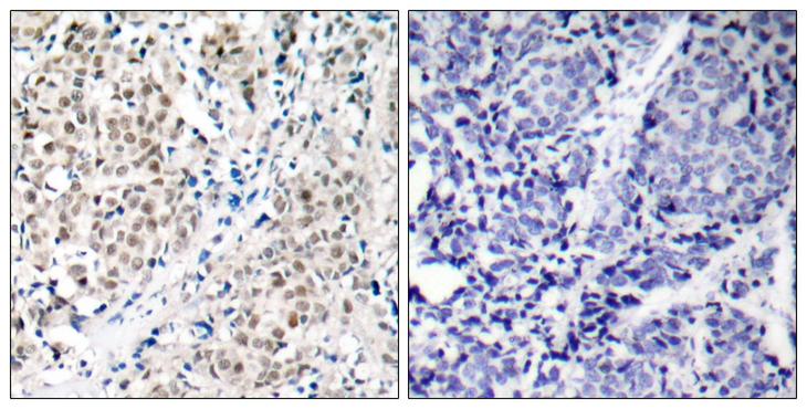 MYC / c-Myc Antibody - Peptide - + Immunohistochemical analysis of paraffin- embedded human breast carcinoma tissue using Myc (Ab-358) antibody.