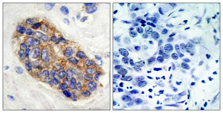 MYC / c-Myc Antibody - Immunohistochemical analysis of paraffin- embedded breast carcinoma. Left: Using Myc (Ab-373) Antibody; Right: The same antibody preincubated with synthesized peptide.