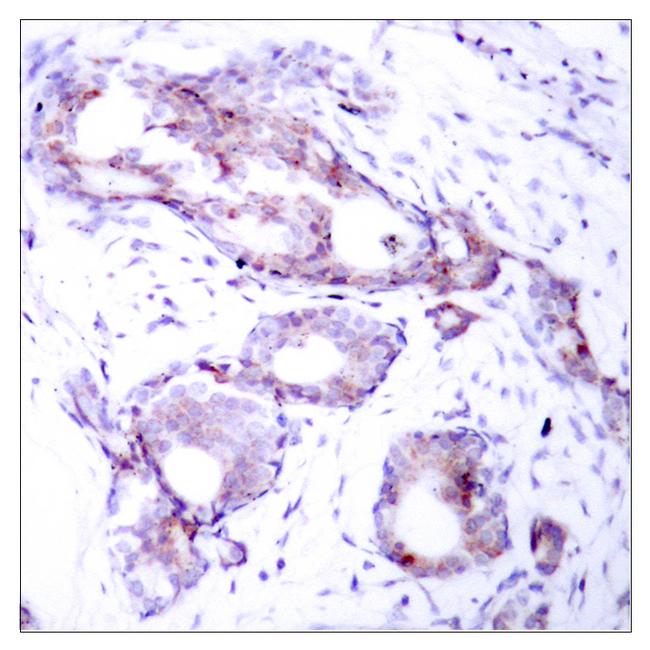 MYC / c-Myc Antibody - Immunohistochemical analysis of paraffin- embedded breast carcinoma, using Myc (Phospho-Ser373) Antibody. Line2: The same antibody preincubated with synthesized phosphopeptide.