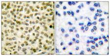 MYC / c-Myc Antibody - Immunohistochemistry analysis of paraffin-embedded human breast carcinoma, using Myc (Phospho-Ser62) Antibody. The picture on the right is blocked with the phospho peptide.