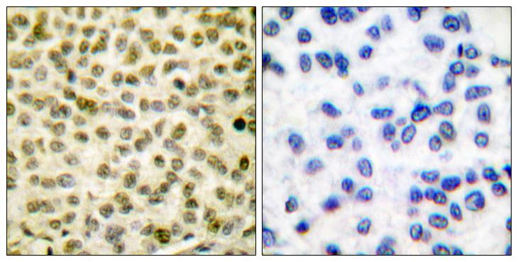 MYC / c-Myc Antibody - P-peptide - + Immunohistochemical analysis of paraffin-embedded human breast carcinoma tissue using Myc (phospho-Ser62) antibody.