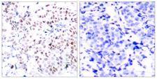 MYC / c-Myc Antibody - Immunohistochemistry analysis of paraffin-embedded human breast carcinoma, using Myc (Phospho-Thr358) Antibody. The picture on the right is blocked with the phospho peptide.