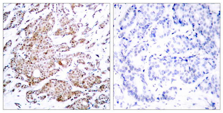 MYC / c-Myc Antibody - Immunohistochemistry analysis of paraffin-embedded human breast carcinoma, using Myc (Phospho-Thr58) Antibody. The picture on the right is blocked with the phospho peptide.