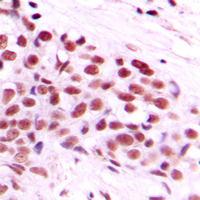 MYC / c-Myc Antibody - Immunohistochemical analysis of c-Myc (pT58) staining in human breast cancer formalin fixed paraffin embedded tissue section. The section was pre-treated using heat mediated antigen retrieval with sodium citrate buffer (pH 6.0). The section was then incubated with the antibody at room temperature and detected using an HRP conjugated compact polymer system. DAB was used as the chromogen. The section was then counterstained with hematoxylin and mounted with DPX.