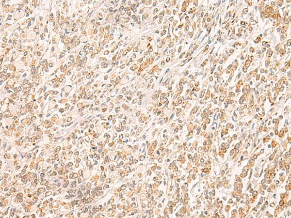 MYCT1 Antibody - Immunohistochemistry of paraffin-embedded Human gastric cancer tissue  using MYCT1 Polyclonal Antibody at dilution of 1:35(×200)