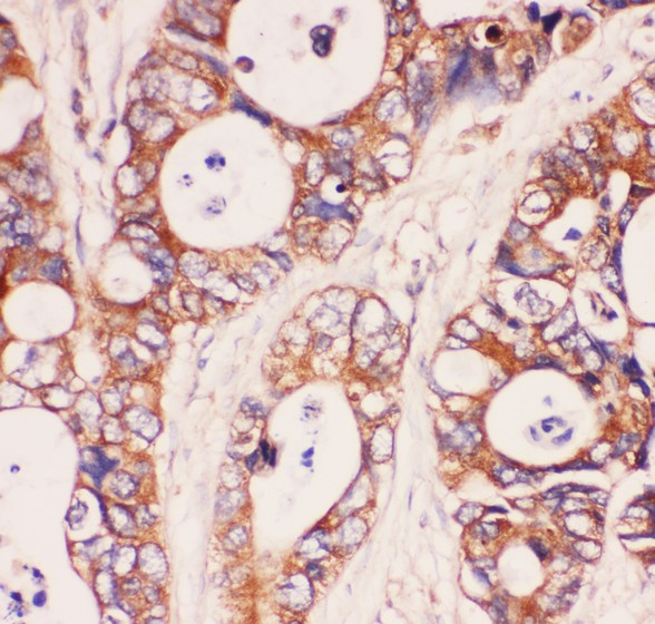 MYD88 Antibody - MyD88 antibody IHC-paraffin: Human Intestinal Cancer Tissue.