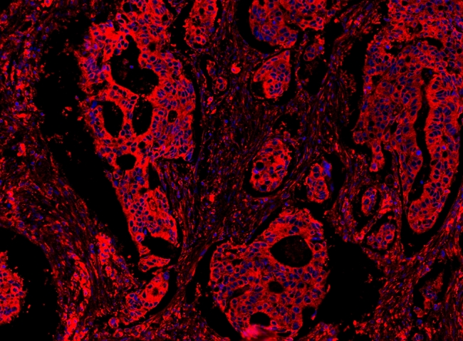 MYD88 Antibody - IF analysis of MYD88 using anti-MYD88 antibody MYD88 was detected in paraffin-embedded section of human colon cancar tissues. Heat mediated antigen retrieval was performed in citrate buffer (pH6, epitope retrieval solution ) for 20 mins. The tissue section was blocked with 10% goat serum. The tissue section was then incubated with 1µg/mL rabbit anti-MYD88 Antibody overnight at 4°C. Cy3 Conjugated Goat Anti-Rabbit IgG was used as secondary antibody at 1:100 dilution and incubated for 30 minutes at 37°C. The section was counterstained with DAPI. Visualize using a fluorescence microscope and filter sets appropriate for the label used.
