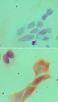 MYD88 Antibody - Immunocytochemistry of MyD88 antibody in MCF-7 cells using an isotype control (top) and Myd88 Antibody (bottom). Myd88 Antibody was used at 5 ug/ml.