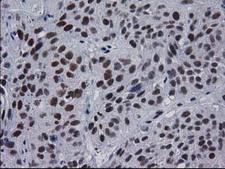 MYD88 Antibody - IHC of paraffin-embedded Carcinoma of Human bladder tissue using anti-MYD88 mouse monoclonal antibody. (Heat-induced epitope retrieval by 10mM citric buffer, pH6.0, 100C for 10min).