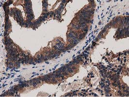 MYD88 Antibody - IHC of paraffin-embedded Carcinoma of Human prostate tissue using anti-MYD88 mouse monoclonal antibody.