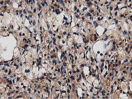 MYD88 Antibody - IHC of paraffin-embedded Carcinoma of Human kidney tissue using anti-MYD88 mouse monoclonal antibody.