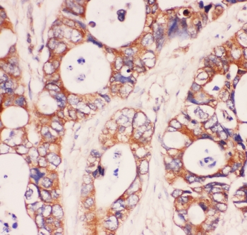 MYD88 Antibody - IHC-P: MyD88 antibody testing of human intestinal cancer tissue