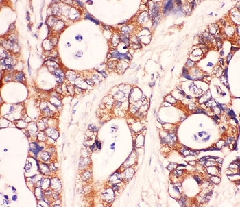 MYD88 Antibody - IHC-P: MyD88 antibody testing of human intestine cancer tissue