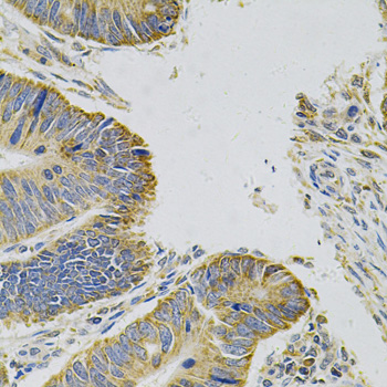 MYD88 Antibody - Immunohistochemistry of paraffin-embedded human colon carcinoma using MYD88 Antibody at dilution of 1:100 (40x lens).