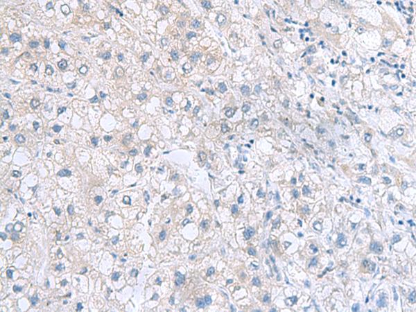 MYDGF / SF20 Antibody - Immunohistochemistry of paraffin-embedded Human liver cancer tissue  using MYDGF Polyclonal Antibody at dilution of 1:70(×200)
