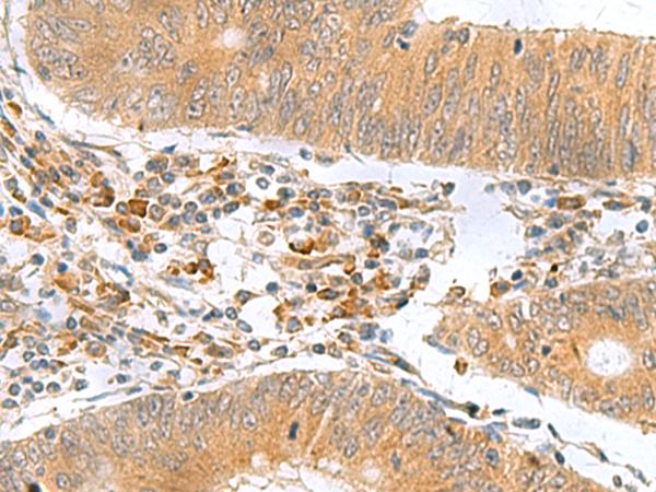 MYDGF / SF20 Antibody - Immunohistochemistry of paraffin-embedded Human colorectal cancer tissue  using MYDGF Polyclonal Antibody at dilution of 1:65(×200)