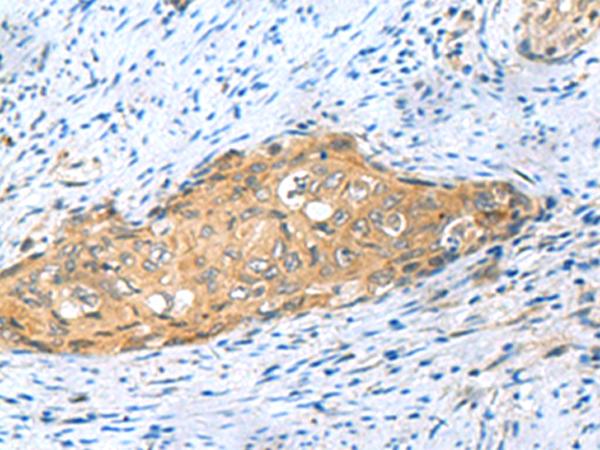 MYDGF / SF20 Antibody - Immunohistochemistry of paraffin-embedded Human cervical cancer tissue  using MYDGF Polyclonal Antibody at dilution of 1:65(×200)