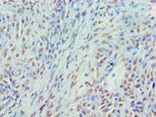 MYEF2 Antibody - Immunohistochemistry of paraffin-embedded human breast cancer using antibody at 1:100 dilution.  This image was taken for the unconjugated form of this product. Other forms have not been tested.