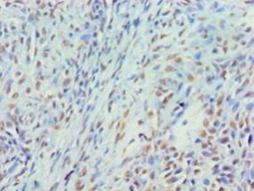 MYEF2 Antibody - Immunohistochemistry of paraffin-embedded human breast cancer using antibody at 1:100 dilution.  This image was taken for the unconjugated form of this product. Other forms have not been tested.