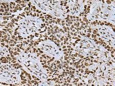 MYEF2 Antibody - Immunohistochemistry of paraffin-embedded Human ovarian cancer tissue  using MYEF2 Polyclonal Antibody at dilution of 1:55(×200)