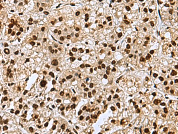 MYEF2 Antibody - Immunohistochemistry of paraffin-embedded Human liver cancer tissue  using MYEF2 Polyclonal Antibody at dilution of 1:70(×200)