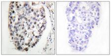 MYF5 / MYF 5 Antibody - Immunohistochemistry analysis of paraffin-embedded human breast carcinoma tissue, using MYF5 Antibody. The picture on the right is blocked with the synthesized peptide.
