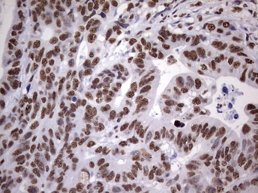 MYF5 / MYF 5 Antibody - IHC of paraffin-embedded Adenocarcinoma of Human colon tissue using anti-MYF5 mouse monoclonal antibody. (Heat-induced epitope retrieval by 1 mM EDTA in 10mM Tris, pH8.5, 120°C for 3min).
