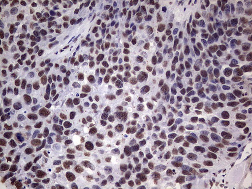 MYF5 / MYF 5 Antibody - IHC of paraffin-embedded Carcinoma of Human kidney tissue using anti-MYF5 mouse monoclonal antibody. (Heat-induced epitope retrieval by 1 mM EDTA in 10mM Tris, pH8.5, 120°C for 3min).