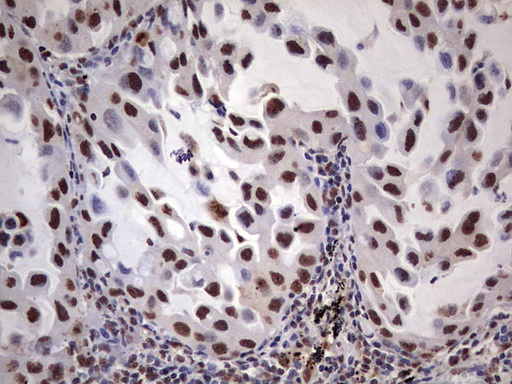 MYF5 / MYF 5 Antibody - IHC of paraffin-embedded Carcinoma of Human lung tissue using anti-MYF5 mouse monoclonal antibody. (Heat-induced epitope retrieval by 1 mM EDTA in 10mM Tris, pH8.5, 120°C for 3min).