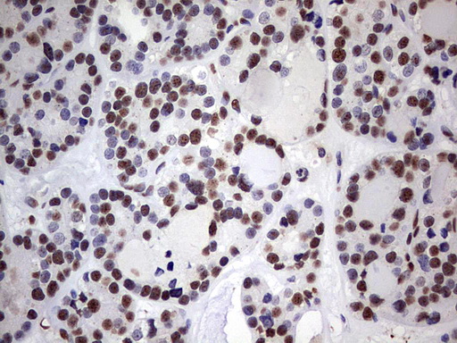 MYF5 / MYF 5 Antibody - IHC of paraffin-embedded Carcinoma of Human thyroid tissue using anti-MYF5 mouse monoclonal antibody. (Heat-induced epitope retrieval by 1 mM EDTA in 10mM Tris, pH8.5, 120°C for 3min).