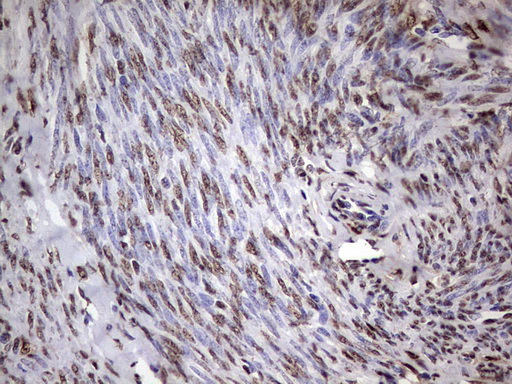 MYF5 / MYF 5 Antibody - IHC of paraffin-embedded Adenocarcinoma of Human endometrium tissue using anti-MYF5 mouse monoclonal antibody. (Heat-induced epitope retrieval by 1 mM EDTA in 10mM Tris, pH8.5, 120°C for 3min).