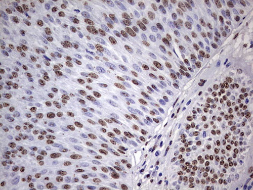 MYF5 / MYF 5 Antibody - IHC of paraffin-embedded Carcinoma of Human bladder tissue using anti-MYF5 mouse monoclonal antibody. (Heat-induced epitope retrieval by 1 mM EDTA in 10mM Tris, pH8.5, 120°C for 3min).