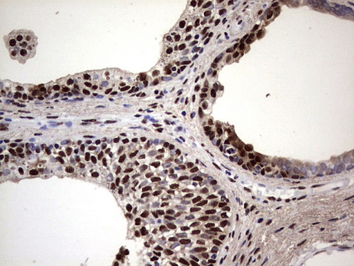 MYF5 / MYF 5 Antibody - IHC of paraffin-embedded Carcinoma of Human prostate tissue using anti-MYF5 mouse monoclonal antibody. (Heat-induced epitope retrieval by 1 mM EDTA in 10mM Tris, pH8.5, 120°C for 3min).