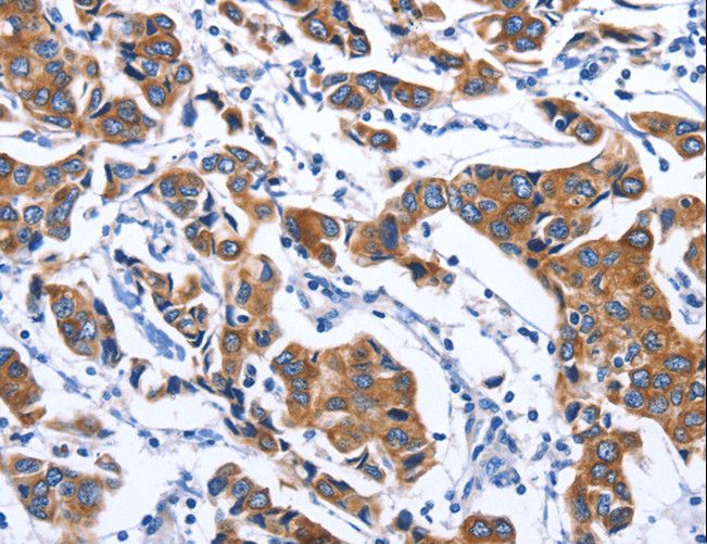 MYH1 Antibody - Immunohistochemistry of paraffin-embedded Human breast cancer using MYH1 Polyclonal Antibody at dilution of 1:40.