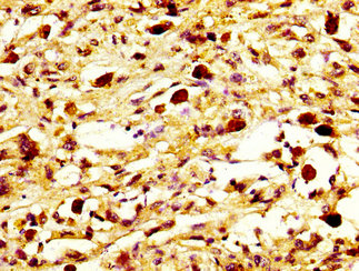 MYH7 Antibody - Immunohistochemistry image at a dilution of 1:800 and staining in paraffin-embedded human melanoma cancer performed on a Leica BondTM system. After dewaxing and hydration, antigen retrieval was mediated by high pressure in a citrate buffer (pH 6.0) . Section was blocked with 10% normal goat serum 30min at RT. Then primary antibody (1% BSA) was incubated at 4 °C overnight. The primary is detected by a biotinylated secondary antibody and visualized using an HRP conjugated SP system.