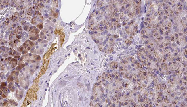 MYHC / MYH6 Antibody - 1:100 staining human pancreas carcinoma tissue by IHC-P. The sample was formaldehyde fixed and a heat mediated antigen retrieval step in citrate buffer was performed. The sample was then blocked and incubated with the antibody for 1.5 hours at 22°C. An HRP conjugated goat anti-rabbit antibody was used as the secondary.