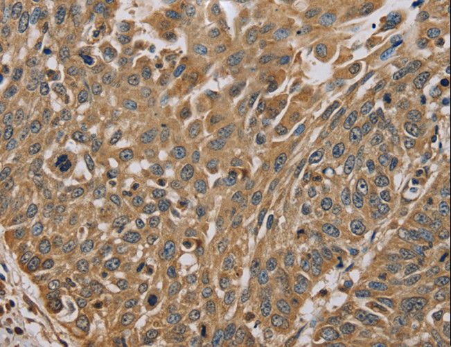 MYL3 Antibody - Immunohistochemistry of paraffin-embedded Human lung cancer using MYL3 Polyclonal Antibody at dilution of 1:45.
