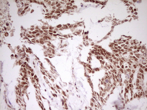 MYL4 Antibody - Immunohistochemical staining of paraffin-embedded Human testicular cancer tissue using anti-MYL4 mouse monoclonal antibody. (Heat-induced epitope retrieval by 1 mM EDTA in 10mM Tris, pH8.5, 120C for 3min,