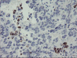 MYL7 Antibody - IHC of paraffin-embedded Adenocarcinoma of Human ovary tissue using anti-MYL7 mouse monoclonal antibody.