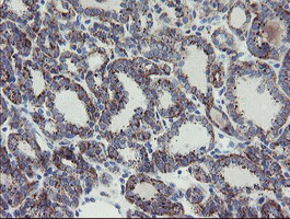 MYL7 Antibody - IHC of paraffin-embedded Carcinoma of Human thyroid tissue using anti-MYL7 mouse monoclonal antibody.